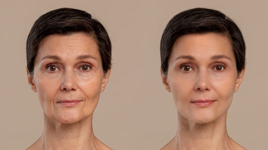 What is Sculptra and How Does it Work Effectively?