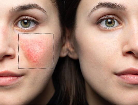 IPL for Rosacea: Benefits, Side Effects, and More